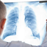 Tot ce trebuie să știi despre cancerul pulmonar, acest ”silent killer”: Cauze, prevenție, tratament, stil de viață Interviu