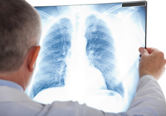 Tot ce trebuie să știi despre cancerul pulmonar, acest <i>”silent killer”</i>: Cauze, prevenție, tratament, stil de viață <span style="color:#990000;font-size:100%;">Interviu</span>