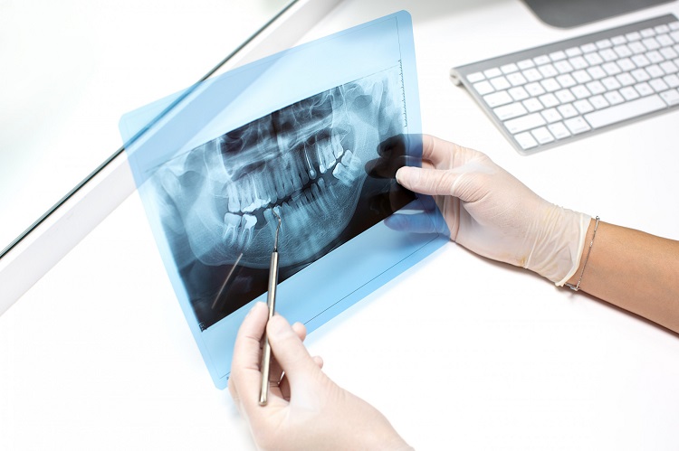 Implantul dentar, o modalitate simplă de a avea un zâmbet perfect și o dantură funcțională, fără compromisuri