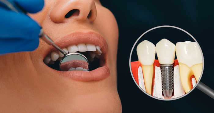 Implant dentar - ce măsuri de igienă orală se impun după intervenție
