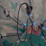 Premieră mondială în transplantul pulmonar, cu ajutorul robotului Da Vinci (Video)