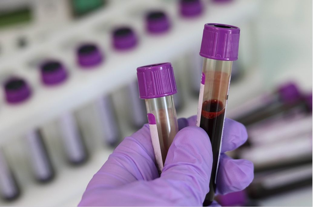 British Scientists Develop Blood Test for Diabetes Risk Prediction