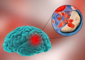 4 cauze ale accidentului vascular cerebral ischemic