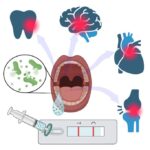 Test la domiciliu pentru diagnosticarea gingivitei