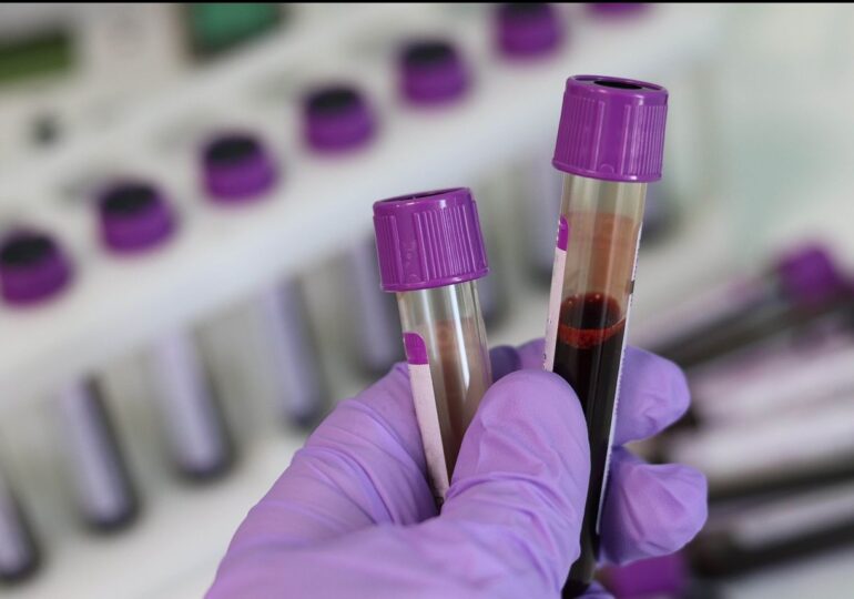 Un simplu test de sânge ar putea diagnostica boala Alzheimer cu precizie