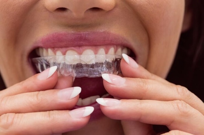 Ai sau nu nevoie de aparat dentar? 4 beneficii ale purtării acestuia