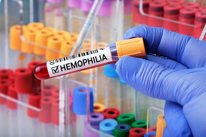 Hemofilia: simptome și cauze