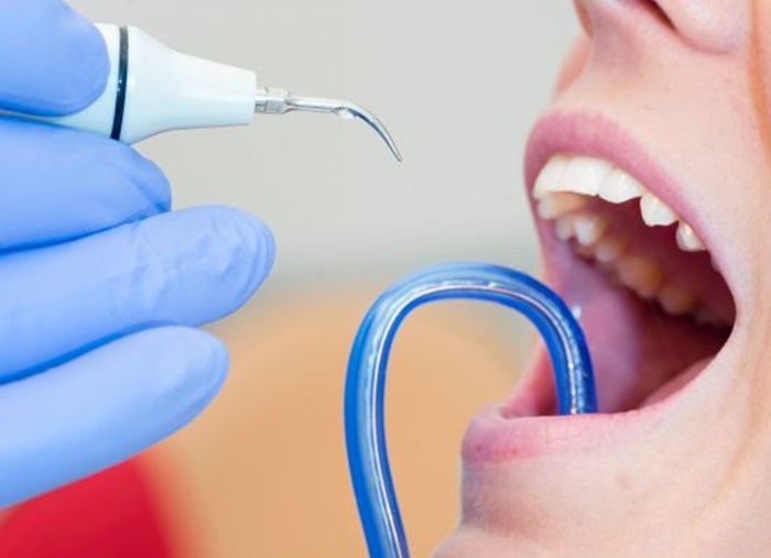 Riscurile la care te expui dacă nu faci detartraj dentar