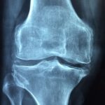 Un nou test de sânge poate detecta osteoartrita cu până la opt ani înainte ca boala să se vadă la radiografie