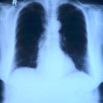 Cancerul pulmonar, din ce în ce mai frecvent. 75% dintre cazurile din România sunt avansate. Cum putem preveni boala