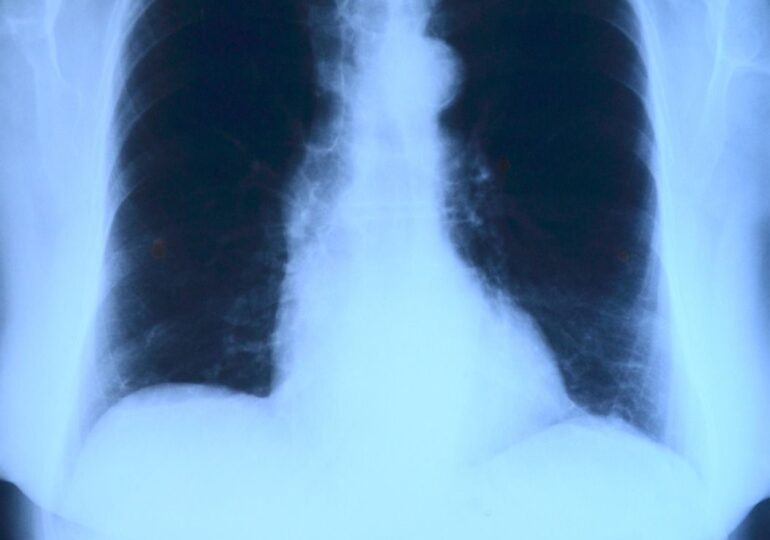 Oamenii de știință au descoperit o corelație între TBC și riscul crescut de cancer