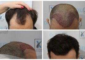 Cât costă implantul de păr la Dr. Felix Hair Implant? Mai puțin decât te aștepți