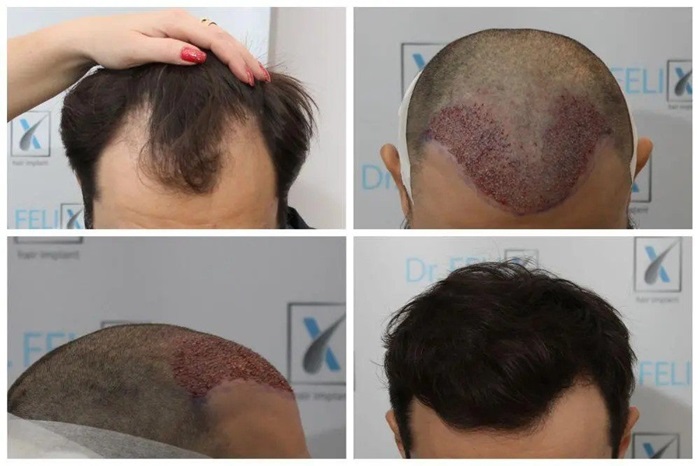 Cât costă implantul de păr la Dr. Felix Hair Implant? Mai puțin decât te aștepți