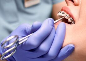 Cum îți poate îmbunătăți ortodonția sănătatea orală și calitatea vieții