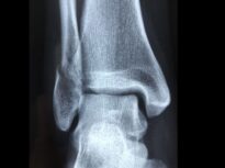 Exercițiile fizice ajută oasele să rămână puternice. Dar dacă nu poți să le faci? Cercetătorii, în fața unei descoperiri ce poate schimba viața a milioane de oameni