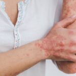 Dermatologia și sănătatea mintală: Un studiu leagă psoriazisul de tulburarea obsesiv-compulsivă