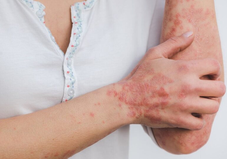 Dermatologia și sănătatea mintală: Un studiu leagă psoriazisul de tulburarea obsesiv-compulsivă