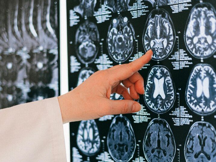 Oamenii de știință au modificat LSD-ul și au creat un nou medicament pentru creier