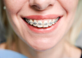 10 întrebări frecvente înainte să îți pui un aparat dentar