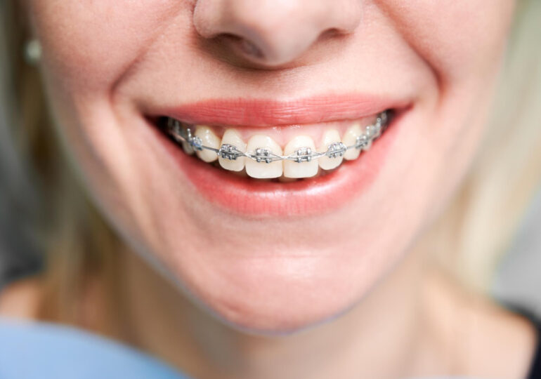 10 întrebări frecvente înainte să îți pui un aparat dentar