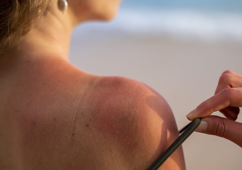 Cel mai bun mod de a evita arsurile de piele provocate de UV nu este crema de protecție solară