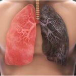 Un român moare în fiecare oră din cauza cancerului pulmonar. Apel de urgență pentru lansarea unui program național de screening