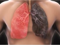 A Romanian dies every hour due to lung cancer. Urgent appeal for the launch of a national screening program