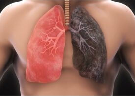 A Romanian dies every hour due to lung cancer. Urgent appeal for the launch of a national screening program