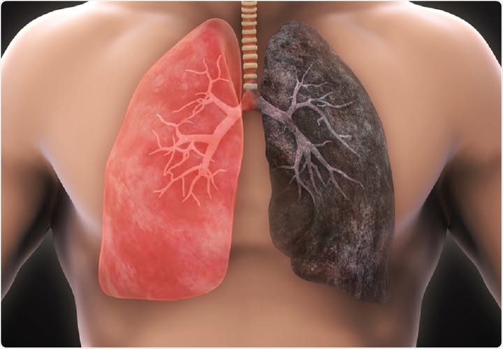 Un român moare în fiecare oră din cauza cancerului pulmonar. Apel de urgență pentru lansarea unui program național de screening