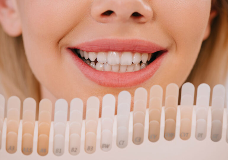 Secretele fatetelor dentare naturale: Tips and tricks