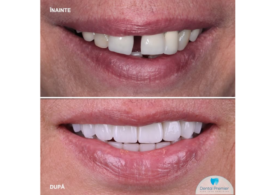 Clinica dentară Dental Premier București răspunde: ce caracteristici are un implant dentar MegaGen