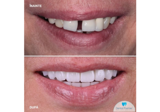 Clinica dentară Dental Premier București răspunde: ce caracteristici are un implant dentar MegaGen