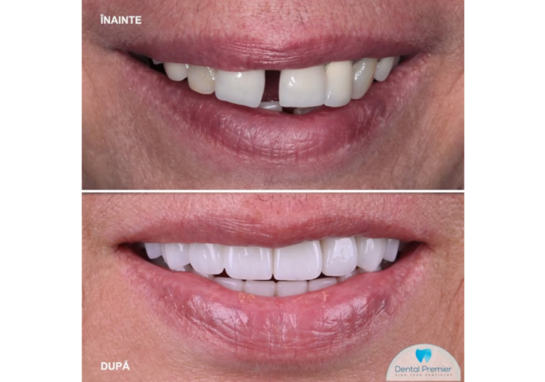 Clinica dentară Dental Premier București răspunde: ce caracteristici are un implant dentar MegaGen