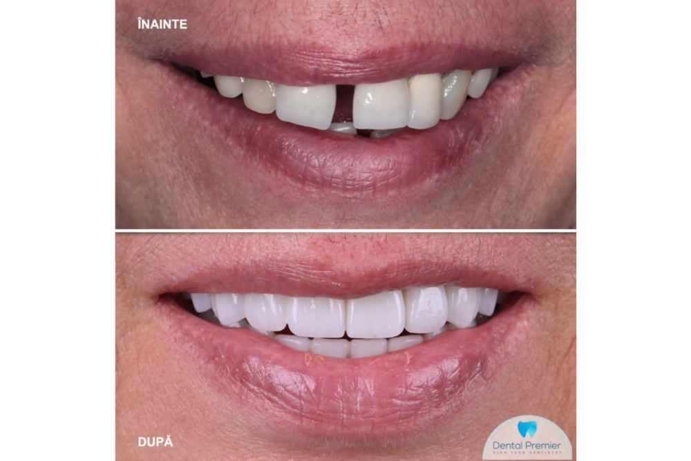 Clinica dentară Dental Premier București răspunde: ce caracteristici are un implant dentar MegaGen