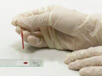 O analiză simplă de sânge ar putea schimba modul în care este diagnosticată boala Alzheimer