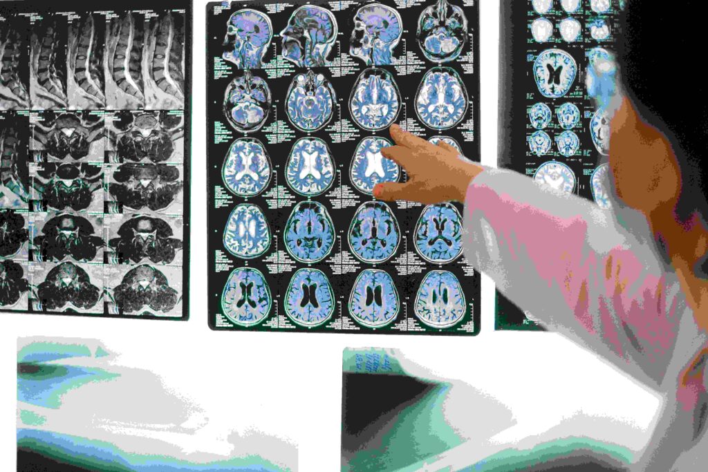 Noi speranțe pentru bolnavii de Alzheimer și familiile lor. Reușită majoră, în laborator