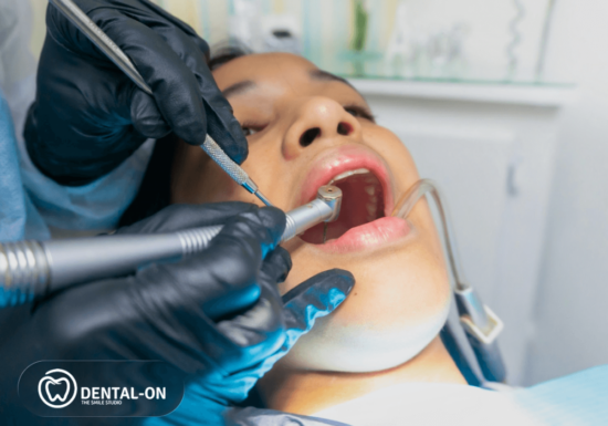 Informații utile pentru pacienți despre obturația de canal de la DENTAL-ON și când este indicată