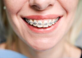 3 semne că este necesar să faci o vizită la ortodont