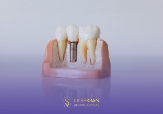 Edentație totală? Clinica Dr. Șerban dezvăluie de ce implanturile Straumann schimbă situația