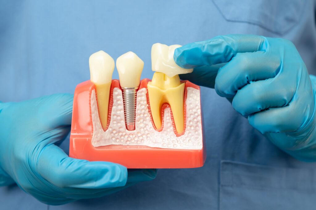 Cât rezistă o coroană dentară? Află cum poți prelungi durata de viață
