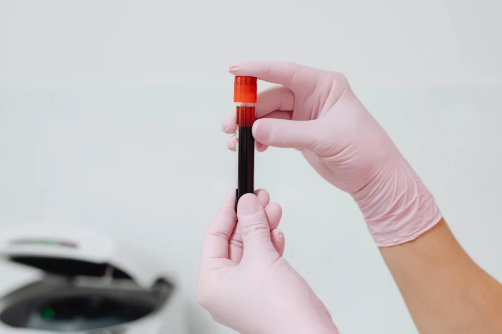 Nou test de sânge pentru diagnosticul bolii Alzheimer, autorizat în UE
