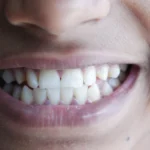 Sângerarea gingiilor ar putea fi un semn precoce al unei afecțiuni mult mai grave