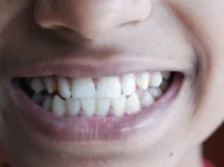 Sângerarea gingiilor ar putea fi un semn precoce al unei afecțiuni mult mai grave
