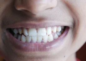 Sângerarea gingiilor ar putea fi un semn precoce al unei afecțiuni mult mai grave