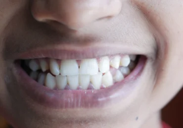 Sângerarea gingiilor ar putea fi un semn precoce al unei afecțiuni mult mai grave