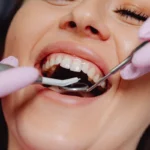 O problemă frecventă a gingiilor, legată de un risc crescut de Alzheimer